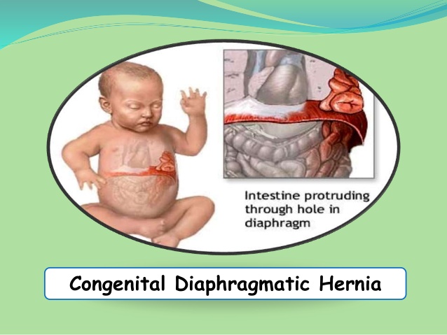 Diaphragmatic Hernia Treatment Mumbai