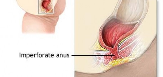 imperforate-anal-surgery