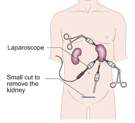 laparoscopic-nephrectomy-mumbai