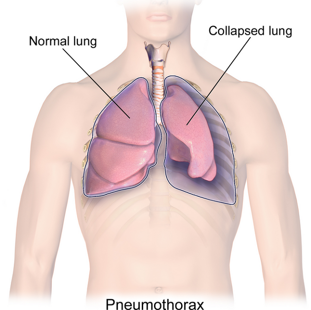 thoracoscopic-surgery