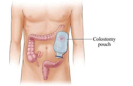 colostomy-surgery-mumbai