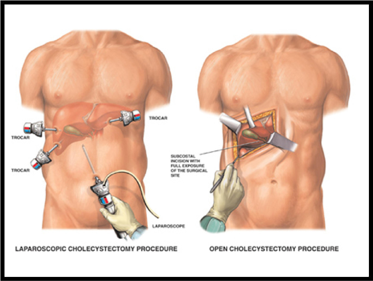 Laparoscopic Cholecystectomy India
