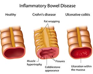 crohn-disease-treatments